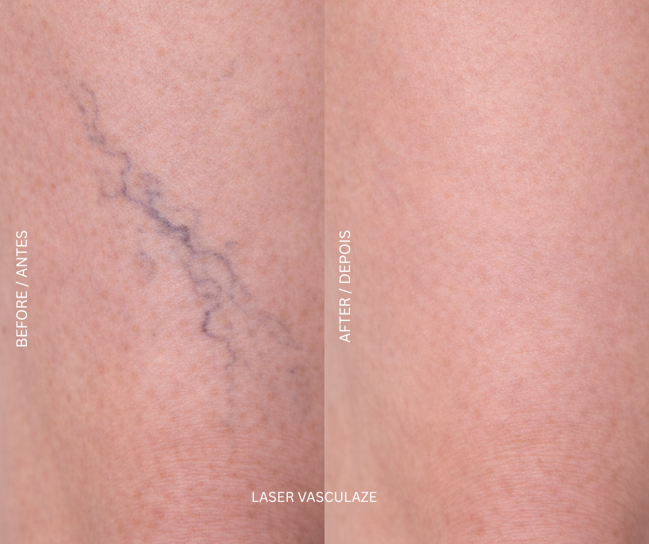 Vasculaze laser treatment device at AD Lisbon
